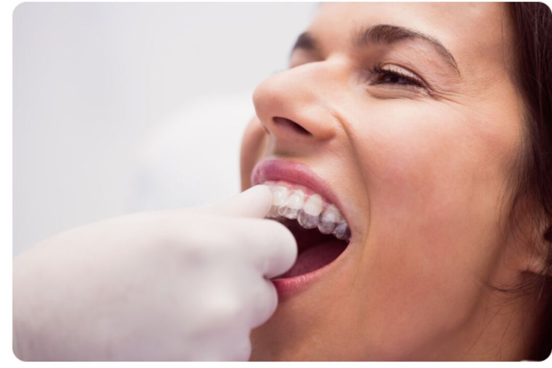 is there an age limit for clear aligners